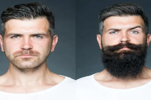 Minoxidil Beard